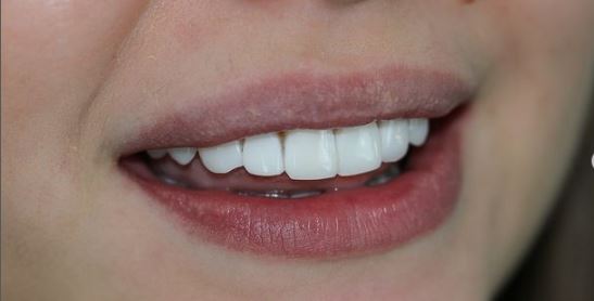 natural white composite bonding Perfomed natural white composite bonding